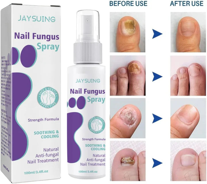 Fungal Nail Treatment